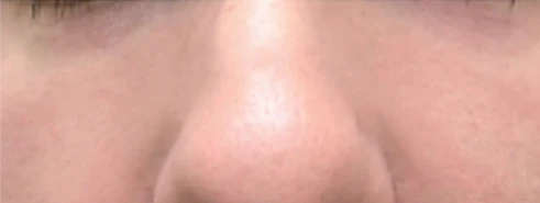 Tear trough after using S100