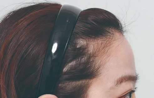 Forehead before using S100