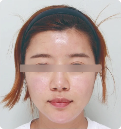 Full-face after using S100