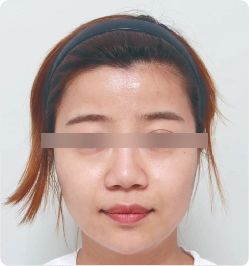 Full-face before using S100