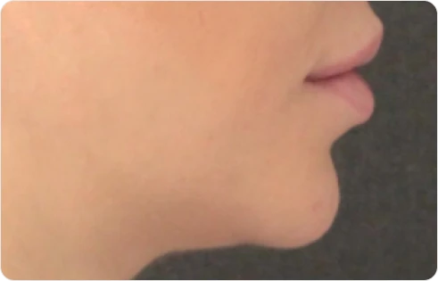 Chin Lip Jawline before using S300