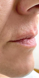 Lip Perioral area before using S300