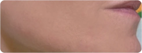Chin Jawline after using S500