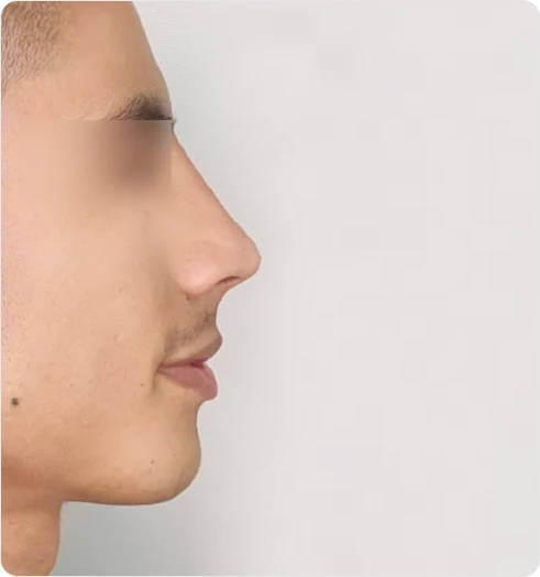 Nose before using S500