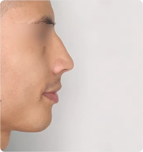 Nose before using S500