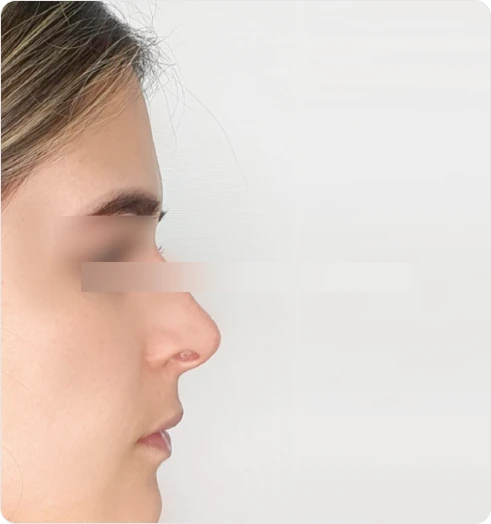 Nose after using S500