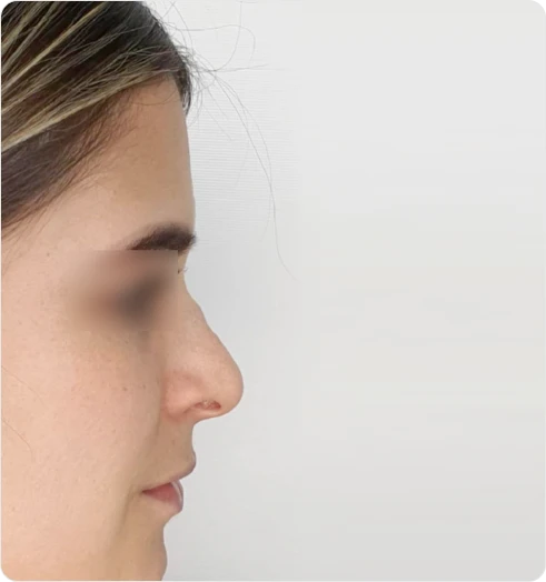 Nose after using S500